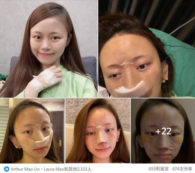 許瑞賢三段式隆鼻